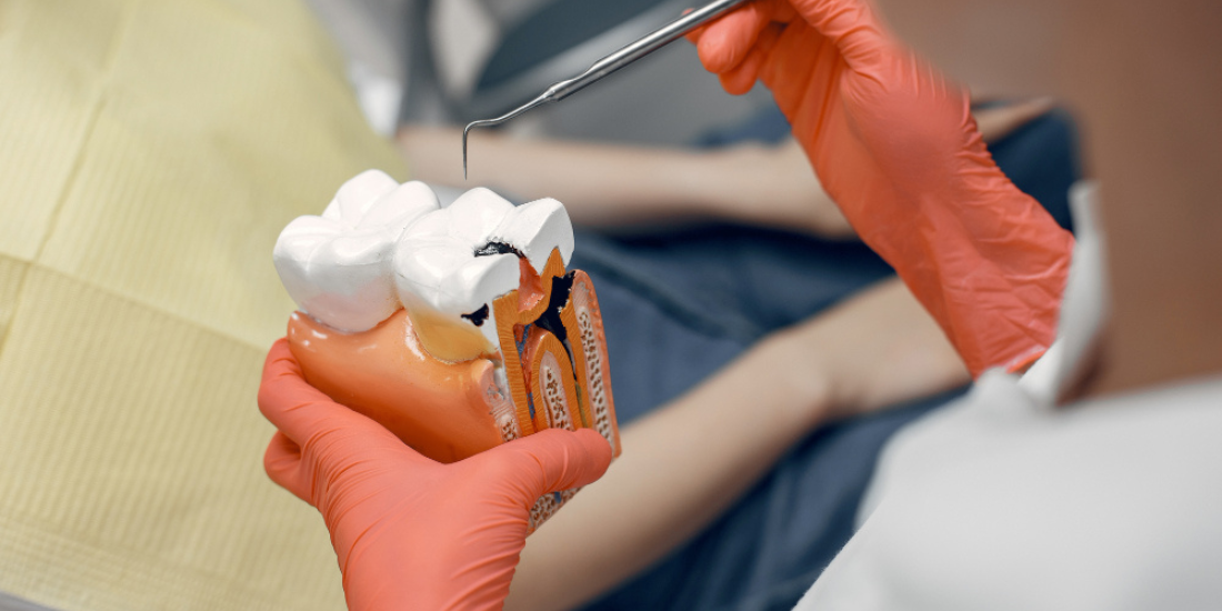 Root Canal Treatment