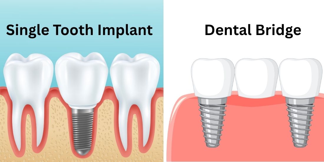 Single Tooth Implant vs Dental Bridge